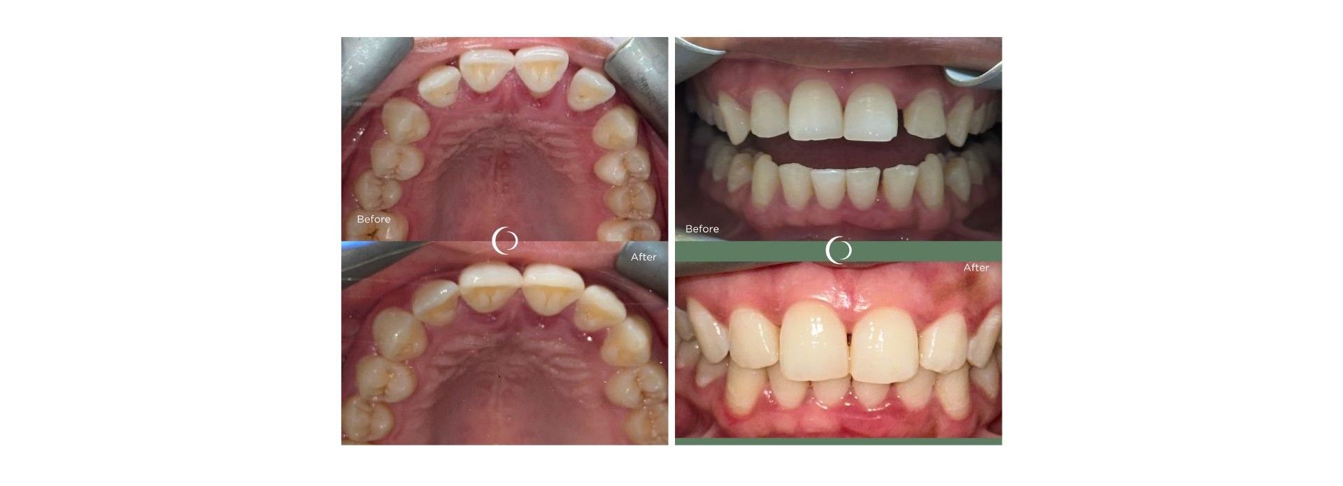 before and after